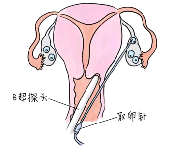 小儿退烧推拿手法 5种济南捐卵宝宝退烧按摩方法